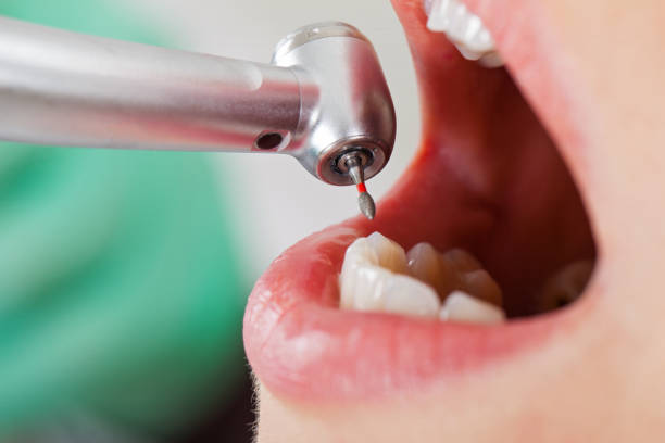 Best Lost Filling or Crown Replacement in Beech Grove, IN